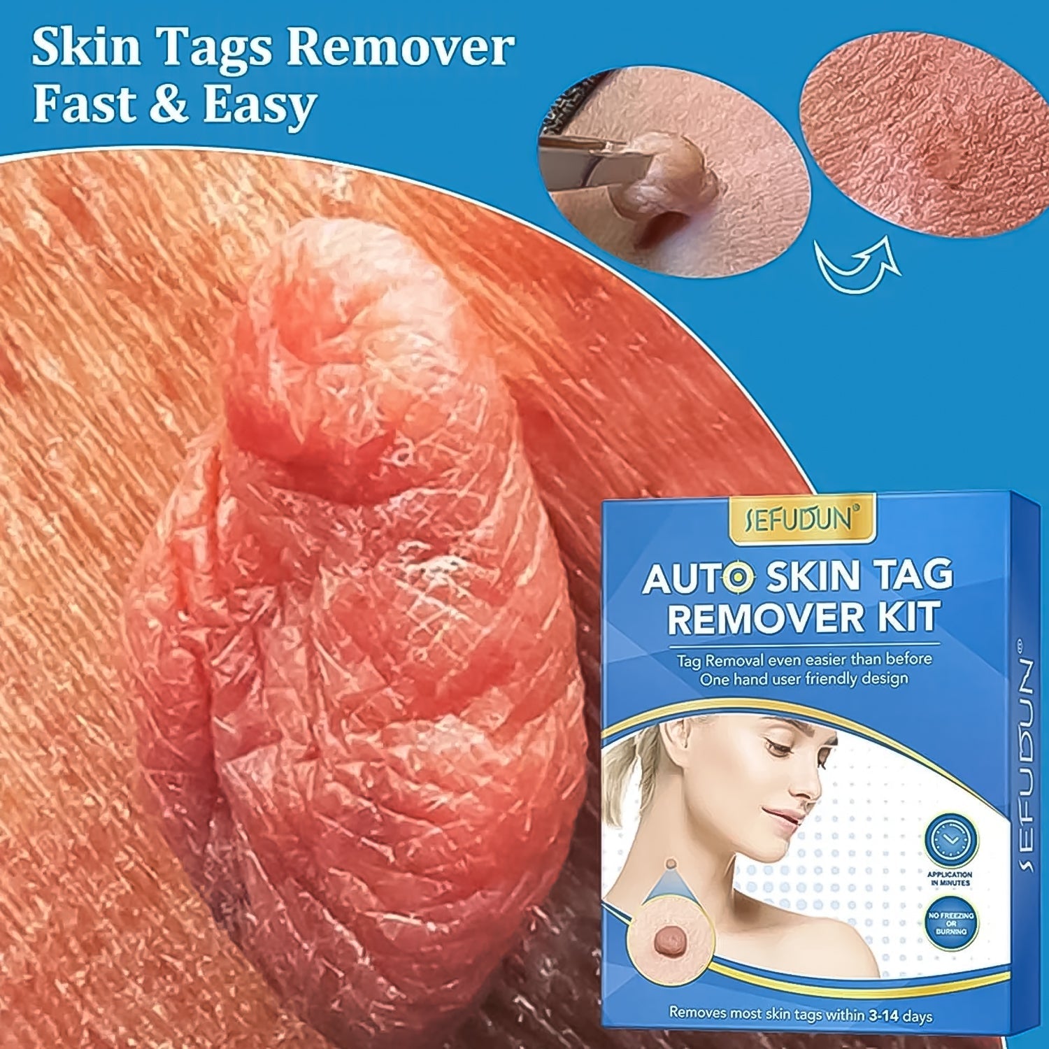 Skin Tag Remover Kit 2 in 1 for Micro to Large (2 mm - 8 mm / 1 Set) Your Brand