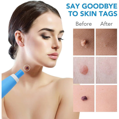 Skin Tag Remover Kit 2 in 1 for Micro to Large (2 mm - 8 mm / 1 Set) Your Brand