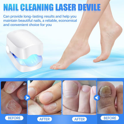 12915 Rechargeable Nail Fungus Treatment For Toenail Toe Nail Fungal Treatment Nail Fungus Laser Device Anti-fungal Nail Treatment For Hand  Feet Infections Remover For Home Use Wukusy
